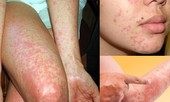 Trời lạnh, có thể chết vì căn bệnh tưởng rất bình thường này