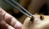 Hỗ trợ gia đình có 5 người bị ong vò vẽ đốt