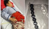Bé trai 10 tuổi hoại tử ruột vì bị bạn ép nuốt 9 viên bi sắt?
