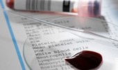Vi rút HIV sống được bao lâu khi ở ngoài cơ thể?