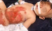 Vấp dây điện ấm siêu tốc, bé 20 tháng tuổi bỏng nặng