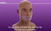 Quá trình cấy ghép mặt được thực hiện như thế nào?