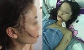 Toàn cảnh thiếu nữ 18 tuổi bị 3 cô gái đánh đập, rạch mặt giữa đêm