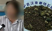 Nhịn ăn sáng nhiều năm, bụng người phụ nữ chứa 7.750 viên sỏi mật