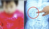 Bổ sung canxi quá liều, bé 9 tháng tuổi thận đầy sỏi