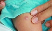 Mẹ tự ý nặn nhọt khiến con phải nhập viện cấp cứu