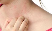 Tia cực tím, ô nhiễm gia tăng kéo theo ung thư da