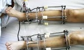 Phẫu thuật kéo dài chân 16cm có ảnh hưởng đến sức khỏe không?