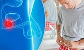 Làm thế nào phát hiện sớm ung thư tuyến tiền liệt?