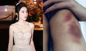 Thủy Tiên ngã chấn thương lưng khi tập vũ đạo trên không