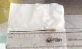 Gắp thành công tăm tre dài gần 10 cm ra khỏi phổi cụ ông