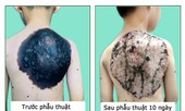 Phẫu thuật thành công “mai rùa” trên lưng bé trai 7 tuổi