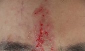 Mù mắt vì tiêm filler nâng mũi