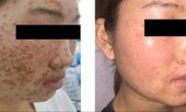 Gặp họa vì dùng bột rửa mặt mua online