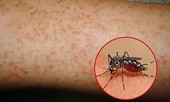 Nam bệnh nhân tử vong do sốt xuất huyết