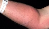 Tự tiêm tinh trùng vào tay, người đàn ông 33 tuổi nhập viện gấp