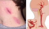 Cô dâu tử vong đêm tân hôn, bác sĩ cảnh báo 4 'điểm chết' trên cơ thể