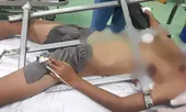 Rơi từ cây cao khi chơi trốn tìm, bé trai bị hàng rào sắt đâm xuyên ngực