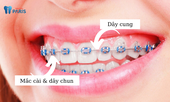 Nên lựa chọn niềng răng mắc cài kim loại thường hay tự buộc?