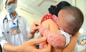 Dịch sởi có nguy cơ bùng phát 'khủng khiếp': Làm gì để tránh bệnh?