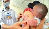 Con chưa đến tuổi tiêm phòng đã mắc sởi: Phòng bệnh thế nào?