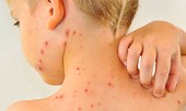 Cách phòng sởi cực kỳ hiệu quả cho trẻ, cha mẹ nên biết