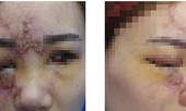 Thiếu nữ phải múc bỏ mắt vì tiêm chất làm đầy để nâng mũi