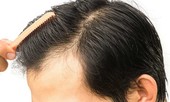 Chi 200 triệu cấy tóc chữa hói, quý ông Hà Nội lĩnh hàng trăm ổ sẹo trên đầu