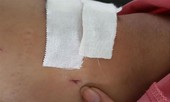 Yêu cầu BV Chợ Rẫy giải trình khẩn vụ 'gãy đốt sống khoan nhầm cẳng chân'