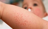 Có dấu hiệu này khi bị sốt, đến viện ngay lập tức kẻo muộn