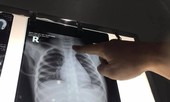 Việt Nam: Bé trai 3 tuổi mắc ung thư tuyến giáp thể tủy di căn