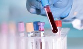 Cắt đôi que thử xét nghiệm HIV: Kết quả trả cho người bệnh sẽ không chính xác?