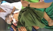 Bé 7 tuổi ở Thái Nguyên bị chó cắn phải khâu 200 mũi đã tử vong