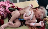 Mẹ bầu không siêu âm, sinh ra con có 3 tay 4 chân ở Ấn Độ