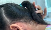 Ghi nhận bệnh nhân nhiễm vi khuẩn 'nguy hiểm' thứ 2 tại Bình Định