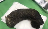 Búi tóc nặng 1kg ở trong dạ dày bé gái 11 tuổi