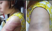 Cô giáo dùng thước đánh tím tay học sinh: Viết bản tường trình do thiếu kinh nghiệm
