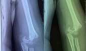 Sở GD&ĐT Hà Nội yêu cầu xác minh vụ trẻ mầm non bị gãy tay trong trường học 