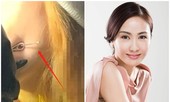 Cô gái trẻ 17 đóng đinh vào má để có má lúm đồng tiền như diễn viên Lê Tư