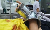 Bị máy cuốn nát bàn tay khi đang xay thịt nấu ăn