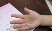 Tưởng con bị bớt sắc tố, đi khám mới biết nhiễm nấm đen