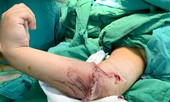 Sau tai nạn, bé trai 8 tuổi đứt lìa cánh tay