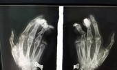 Điện thoại phát nổ, nam thanh niên dập nát bàn tay