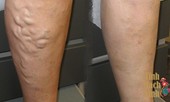 Phòng và điều trị suy giãn tĩnh mạch chi dưới theo quan điểm của Y học cổ truyền