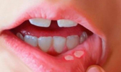 Nhiệt miệng, nhiệt lưới, nhiệt lợi tái phát – Xem ngay giải pháp