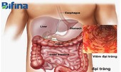 Mách bạn bí kíp hết khổ vì viêm đại tràng