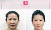 Khám phá công nghệ trẻ hoá hiện đại nhất mang tên 'Tái cấu trúc ngoại vi'