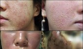 Nam thanh niên 'nát cả người' vì dùng thuốc trị mụn mua trên mạng