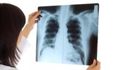 Hai ca viêm phổi cấp ở Trung Quốc tử vong, Việt Nam đã ghi nhận người mắc chưa?