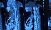 Người phụ nữ Việt Nam bị ‘u đi lạc’, thế giới chỉ vài ca mắc